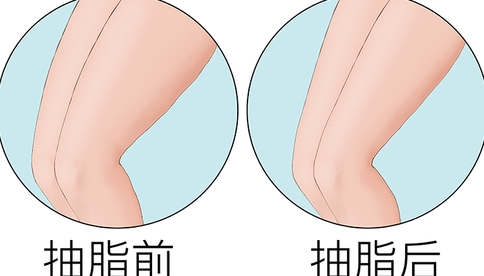抽脂可以瘦腿吗？抽脂瘦腿有什么局限性？