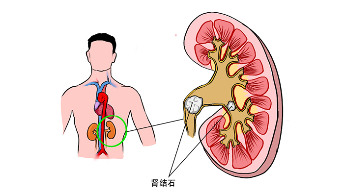 肾结石食疗方法?怎么预防肾结石？