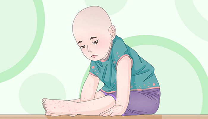 如何预防手足口病