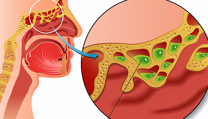 鼻炎的症状是什么？是什么原因导致的？
